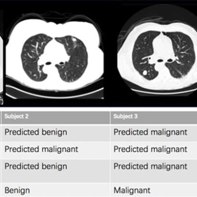 New Deep Learning Technologies for Early Lung Cancer Detection Research