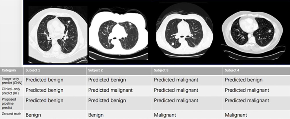 New Deep Learning Technologies For Early Lung Cancer Detection Research ...