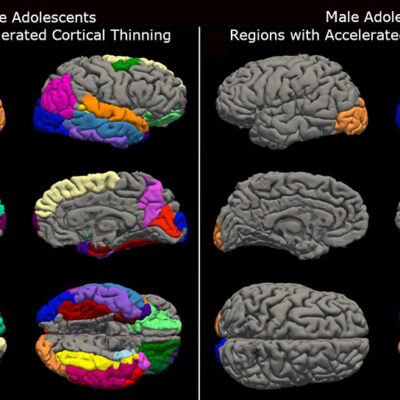 COVID-19 Lockdowns Prematurely Aged Teenage Brains, UW Study Shows